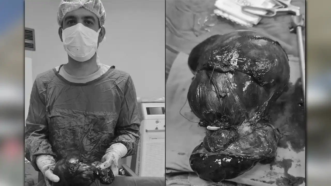 Uşak’ta 12 cm’lik Böbrek Tümörü Başarıyla Çıkarıldı!