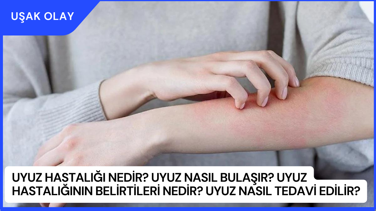 Uyuz Hastalığı Nedir? Uyuz Nasıl Bulaşır? Uyuz Hastalığının Belirtileri Nedir? Uyuz Nasıl Tedavi Edilir?