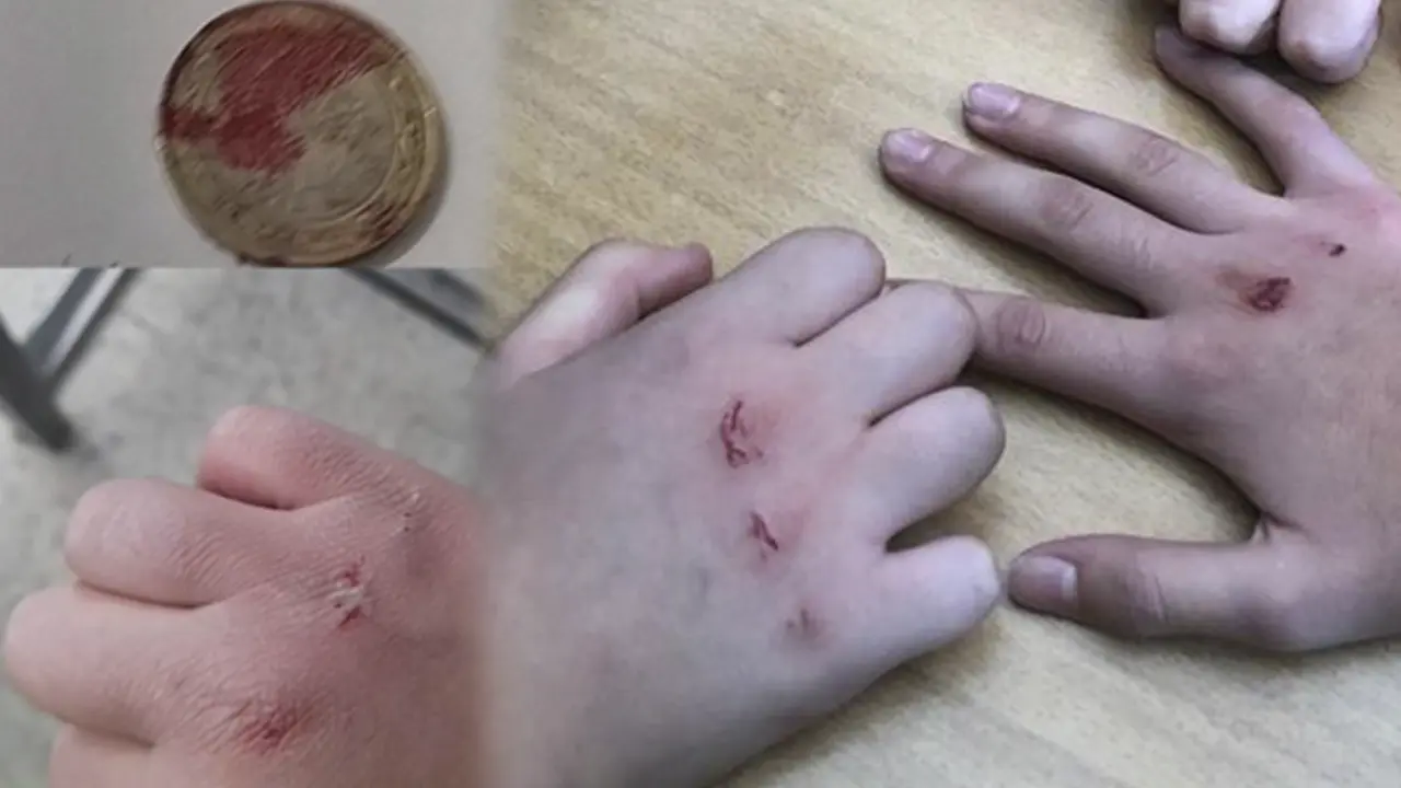 Uşak’ta Kanlı Para salgını: Öğrencileri bekleyen yeni tehlike! Doktorlar uyardı…